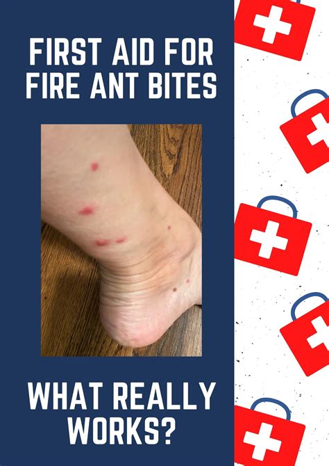 fire ants bites treatment symptoms